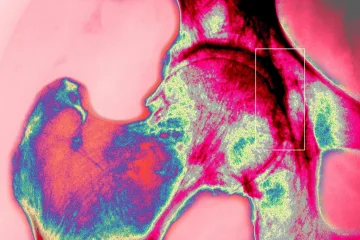 Bone is a wonderful material. Scientists are challenging physics to imitate it for more permanent replacements.