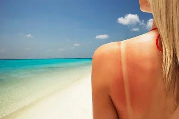 Kujdesi dermatologjik në verë: Si të mbrojmë lëkurën nga dëmtimet e diellit?