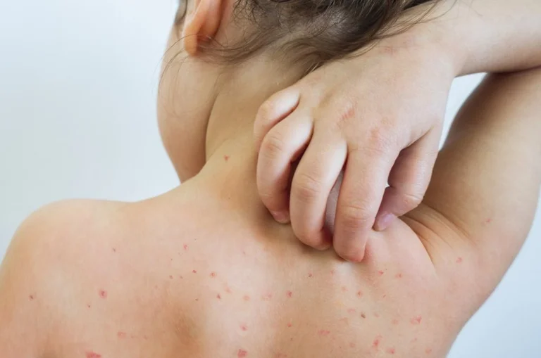 IKKPK: 63 measles cases in Kosovo, 11 new ones over last week