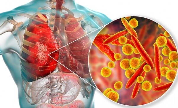 ​Çfarë ndodh me mushkëritë e njerëzve kur infektohen koronavirus